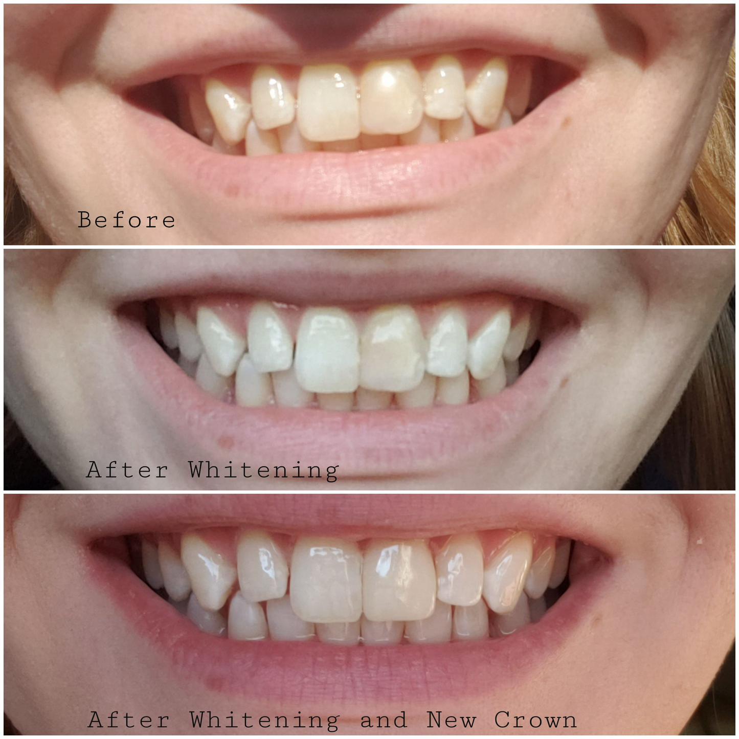 Opalescence Go 15- Prefilled Teeth Whitening Trays